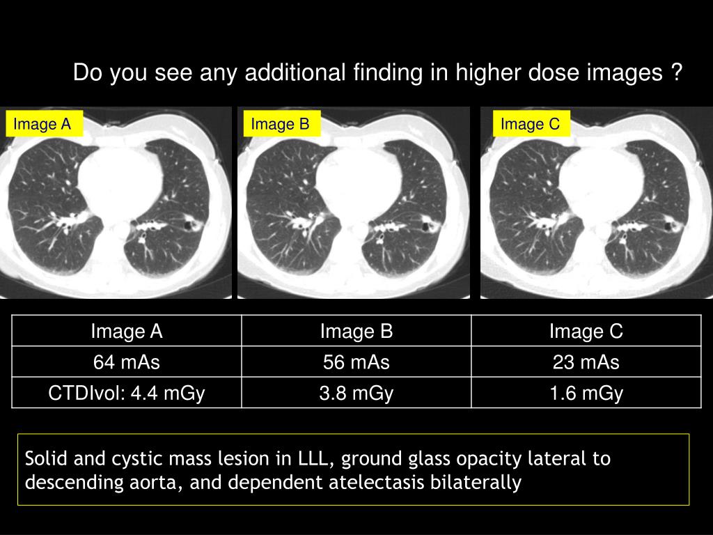 Ppt Image Gallery Lesion Detection On Low Dose Chest Ct Powerpoint Hot Sex Picture
