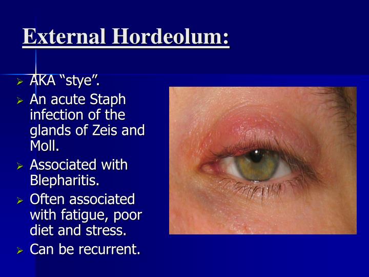 PPT - Posterior Blepharitis PowerPoint Presentation - ID:3336265