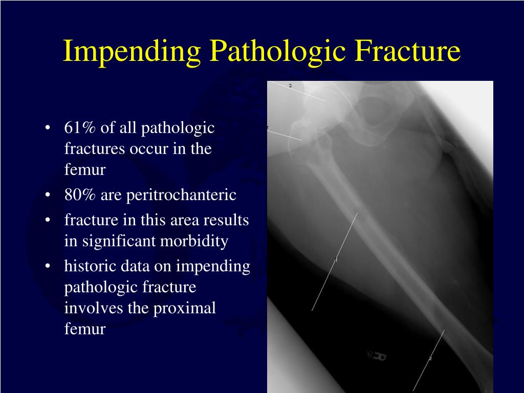 treatment of pathological fracture treatment of pathological fracture