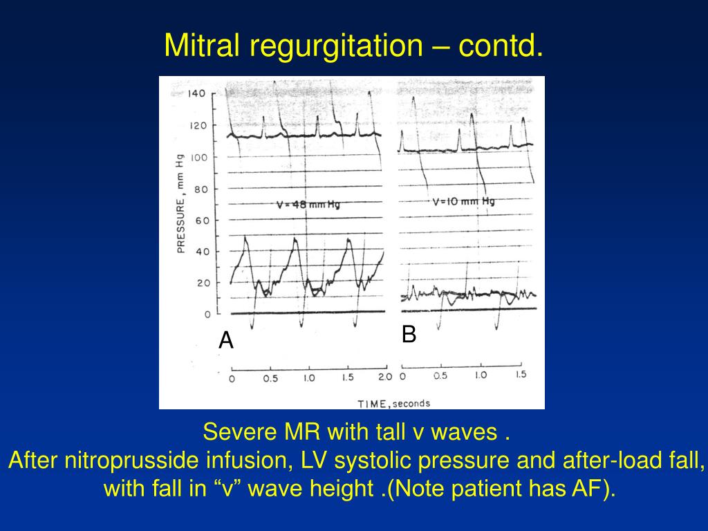 PPT CathLab Hemodynamics I Pressure tracings in the diseased