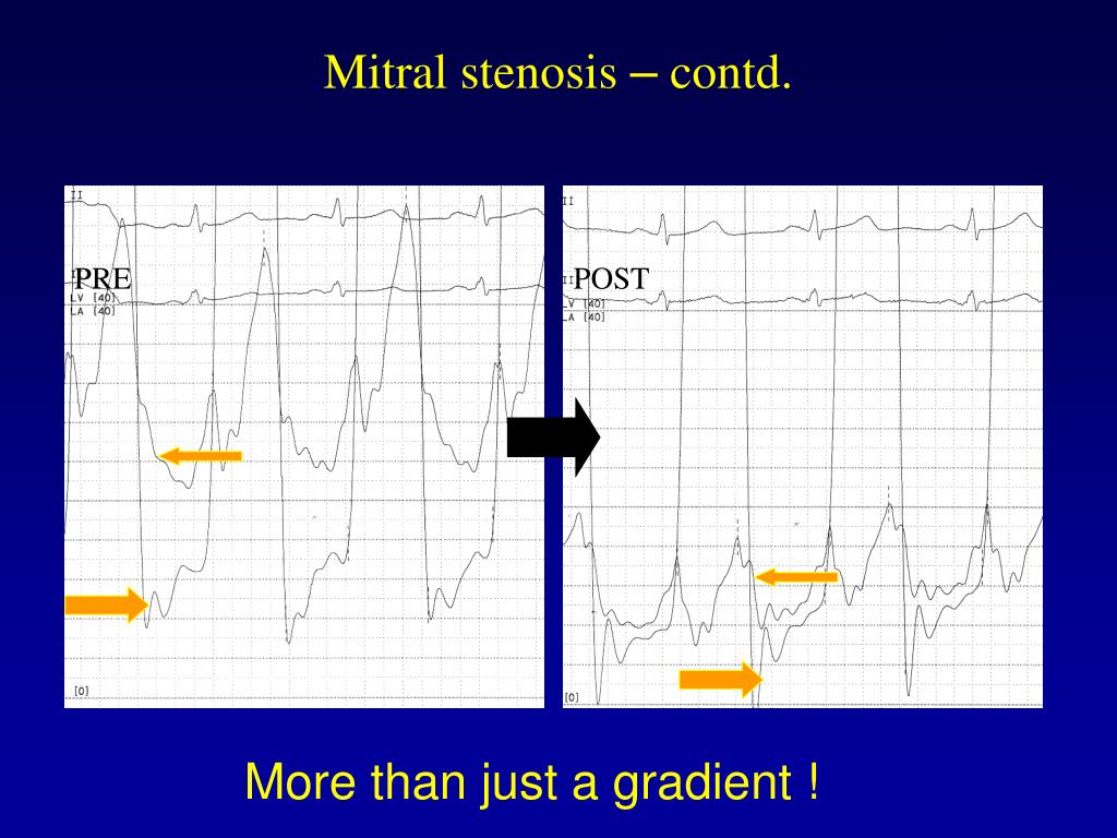PPT CathLab Hemodynamics I Pressure tracings in the diseased