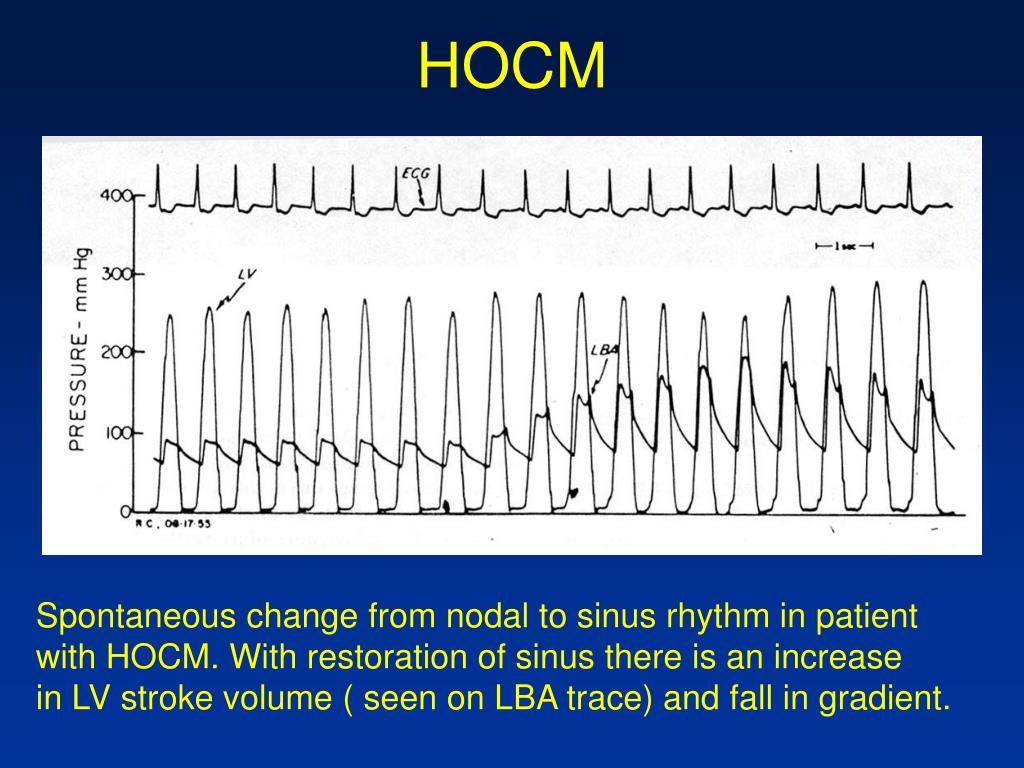 PPT CathLab Hemodynamics I Pressure tracings in the diseased