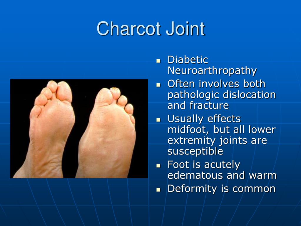 PPT Diagnosis and Treatment of Common Foot Conditions PowerPoint