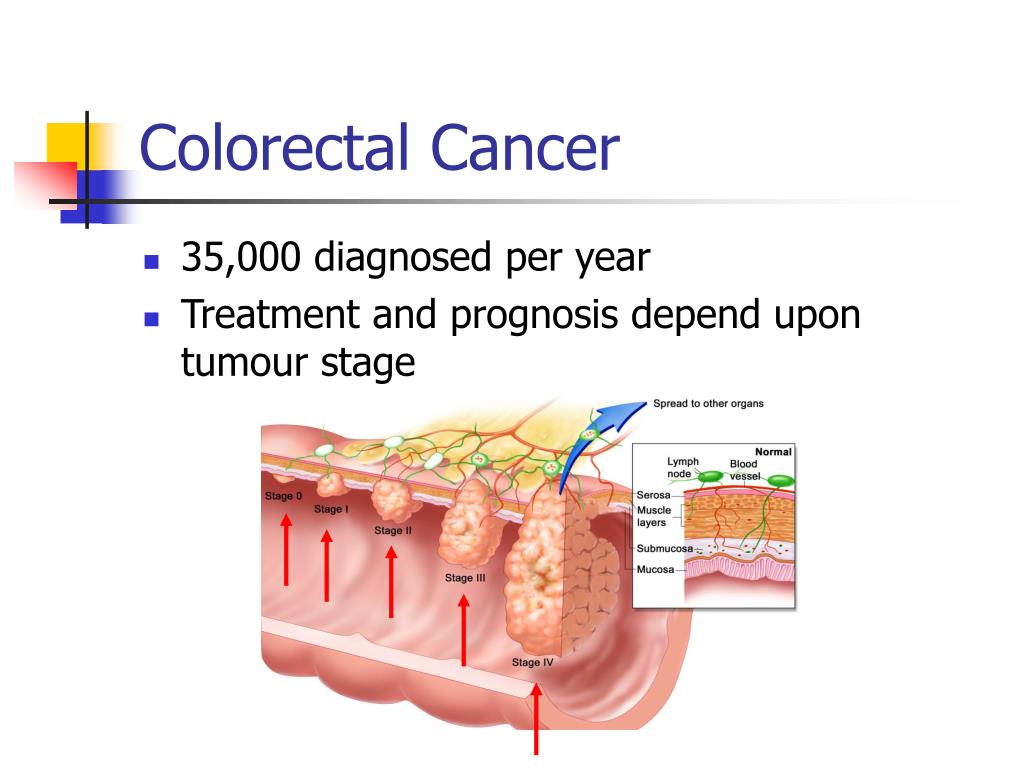 PPT - Microsatellite Instability in Sporadic Colorectal Cancer: A ...