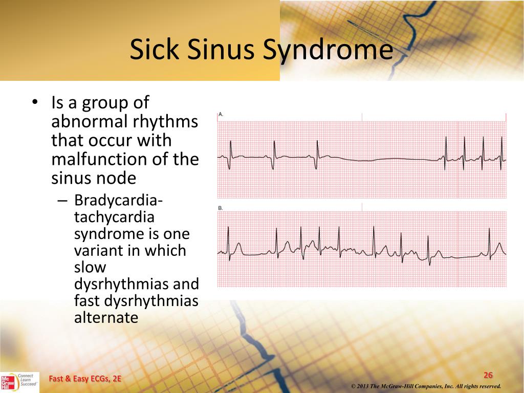 sick sinus syndrome canine