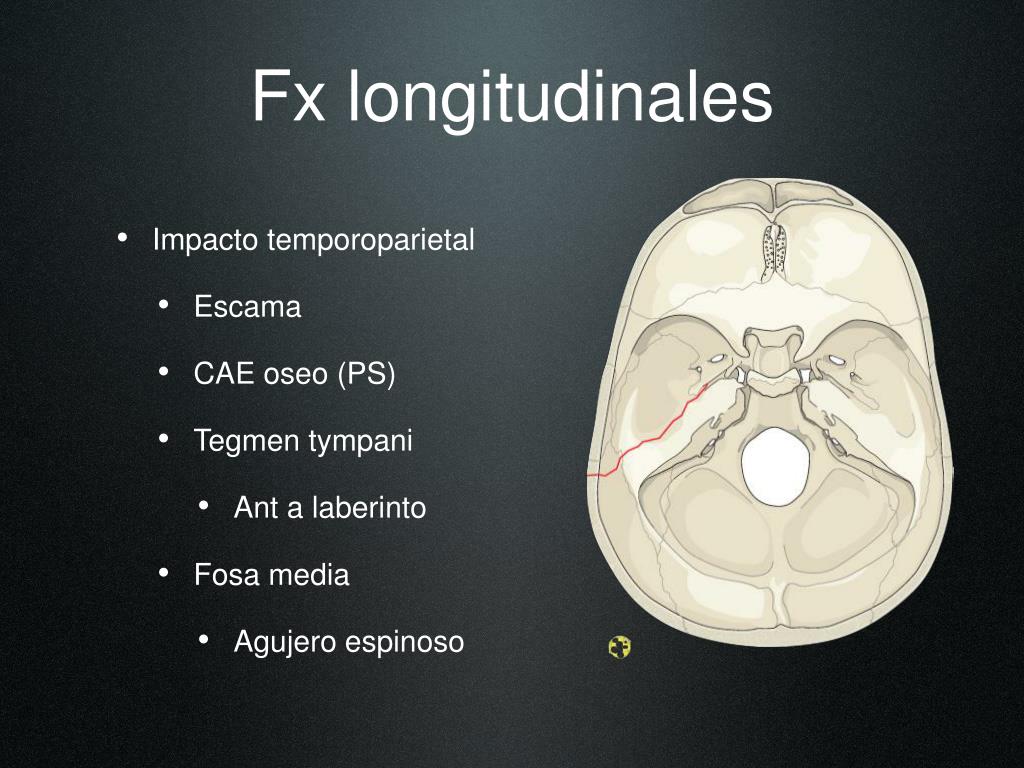 PPT Fracturas Del Hueso Temporal Evaluaci n Y Manejo PowerPoint ppt-fracturas-del-hueso-temporal-evaluaci-n-y-manejo-powerpoint