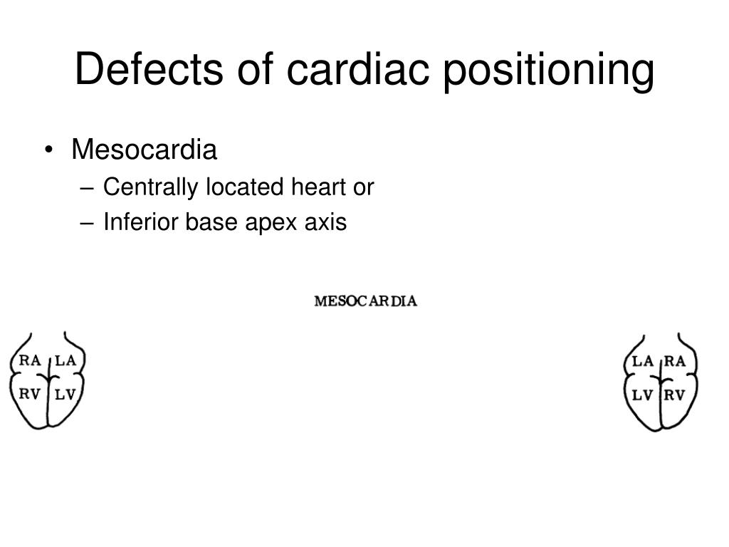 situs inversus ambigus adalah PPT Congenital heart defects Anatomic consideration 