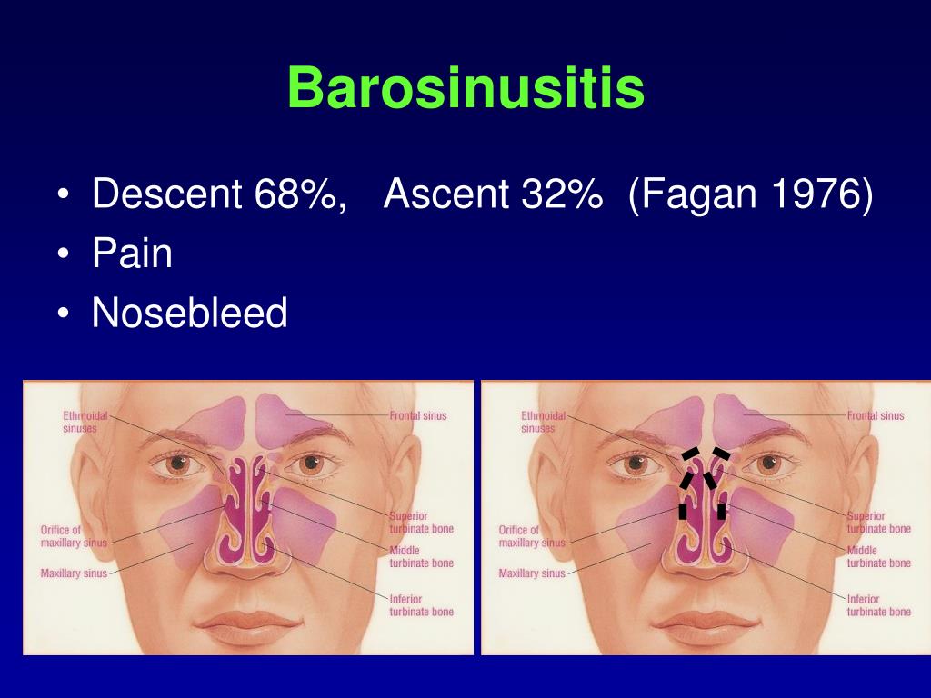 symptoms of barotrauma ear