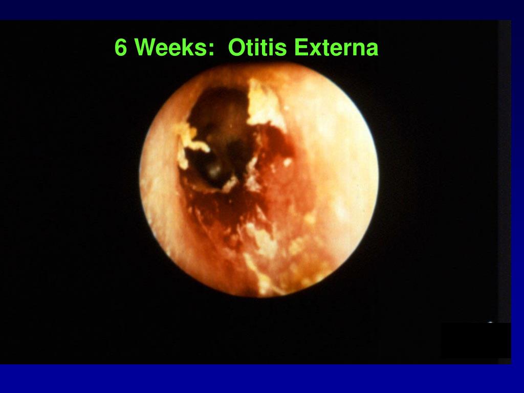 barotrauma otic barotrauma otic