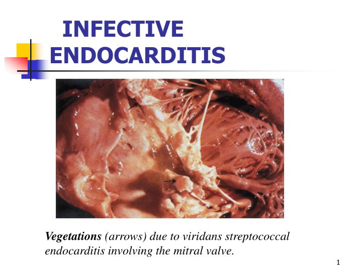 Image result for infective endocarditis