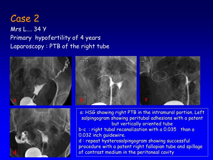 PPT SELECTIVE HYSTEROSALPINGOGRAPHY AND TUBAL RECANALIZATION WHEN