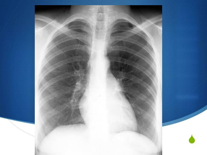 PPT Pneumothorax PowerPoint Presentation, free download ID3357935