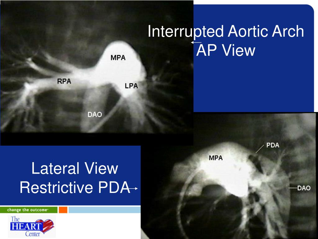 interrupted aortic arch vsd interrupted aortic arch vsd