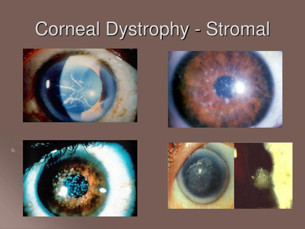 Ppt Disorders Of The Cornea Powerpoint Presentation Free Download Id3361271 