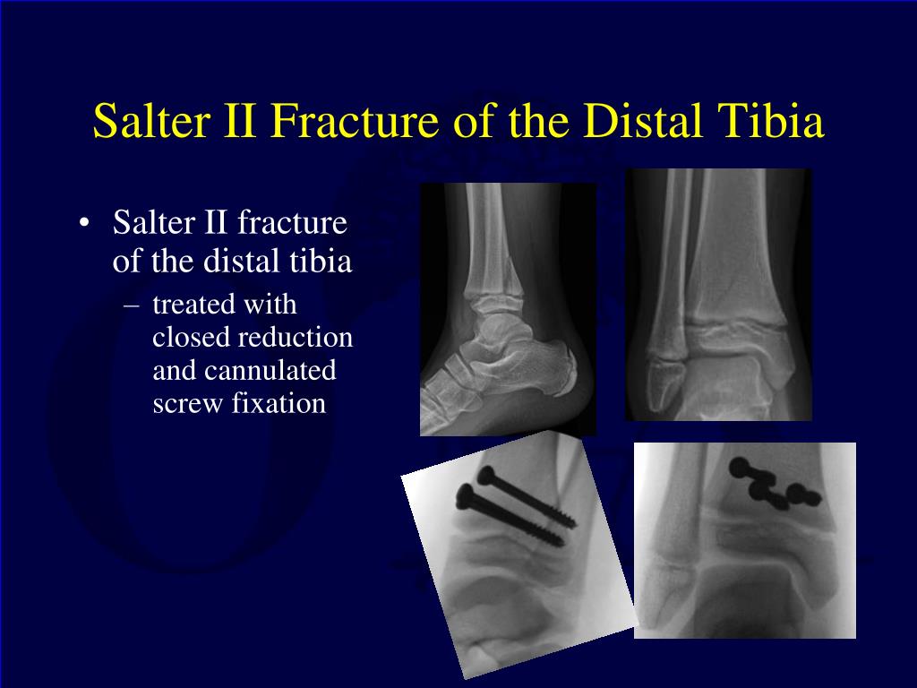 salter harris 2 fracture salter harris 2 fracture