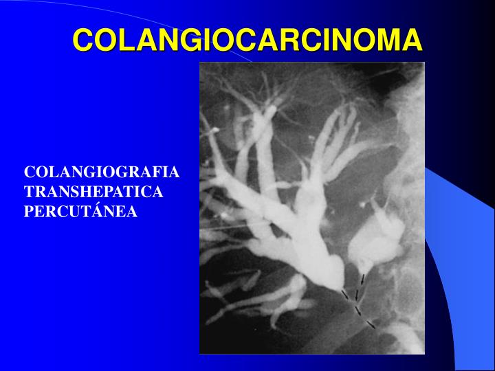 PPT - TUMORES MALIGNOS DE VÍAS BILIARES PowerPoint Presentation - ID ...