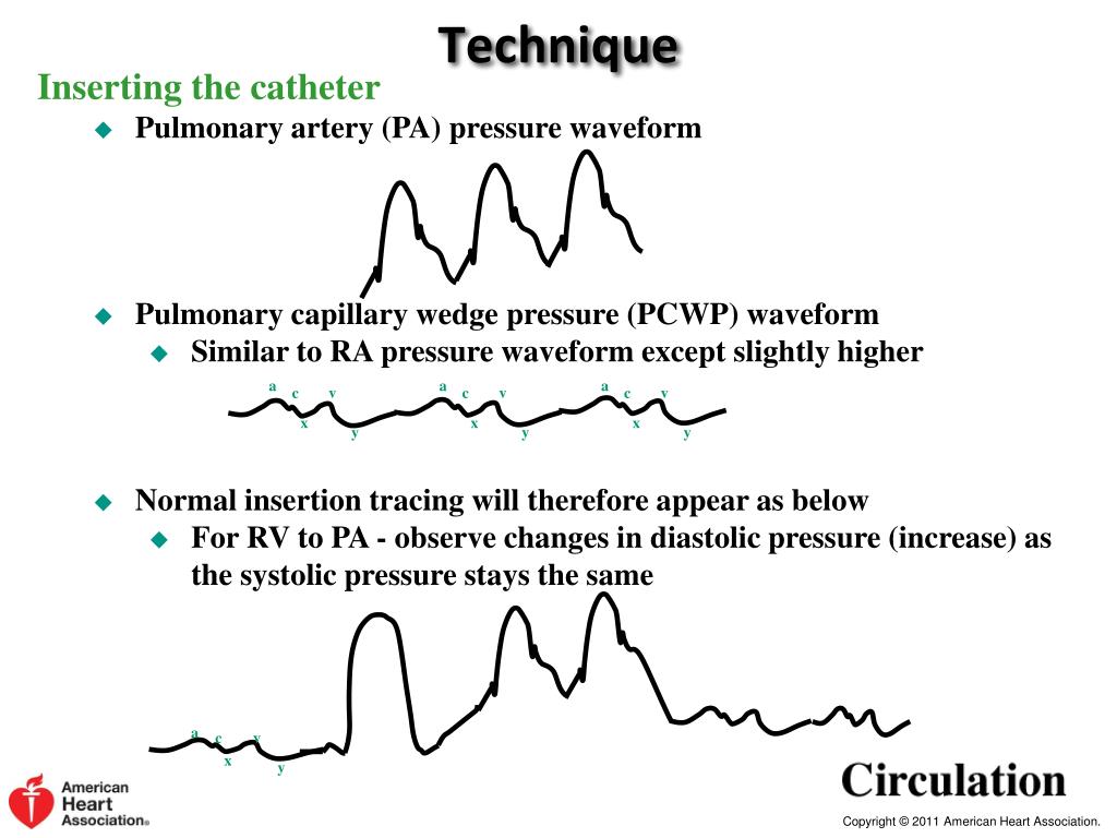 Pulmonary Capillary Wedge Pressure P2 Hemodynamics And Shock pulmonary-capillary-wedge-pressure-p2-hemodynamics-and-shock