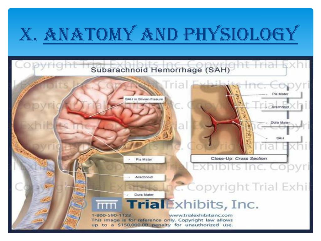 Subarachnoid Hemorrhage (SAH) - Trial Exhibits Inc.