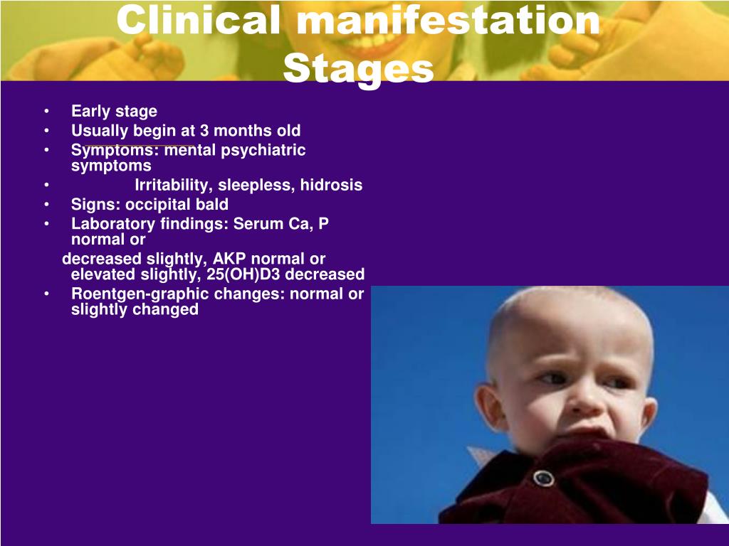 PPT - Rickets: Etiology, pathogenesis, clinical features, diagnostics ...