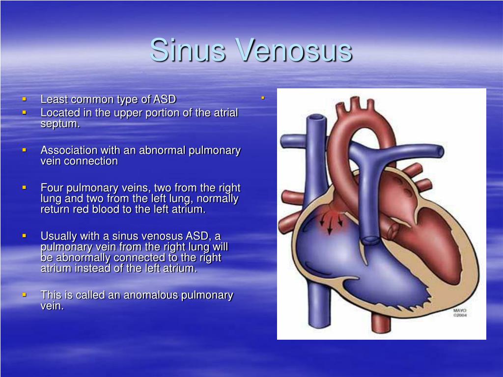 PPT - Atrial Septal Defect PowerPoint Presentation, free ...
Sinus Venosus Asd