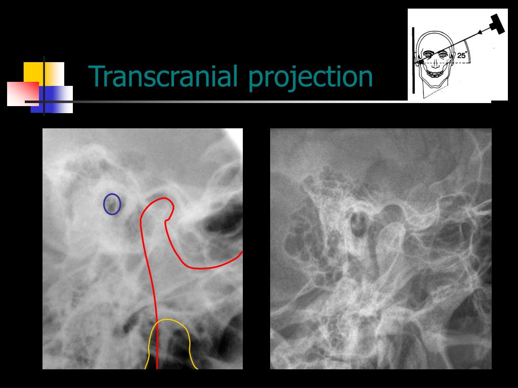 PPT Radiographic Examinations Of The Temporomandibular Joint PPT Radiographic Examinations Of The Temporomandibular Joint