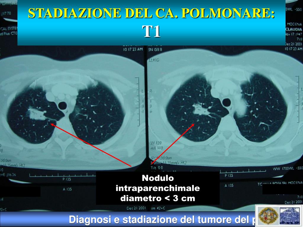 PPT DIAGNOSI E STADIAZIONE DEL TUMORE POLMONARE PowerPoint ppt-diagnosi-e-stadiazione-del-tumore-polmonare-powerpoint