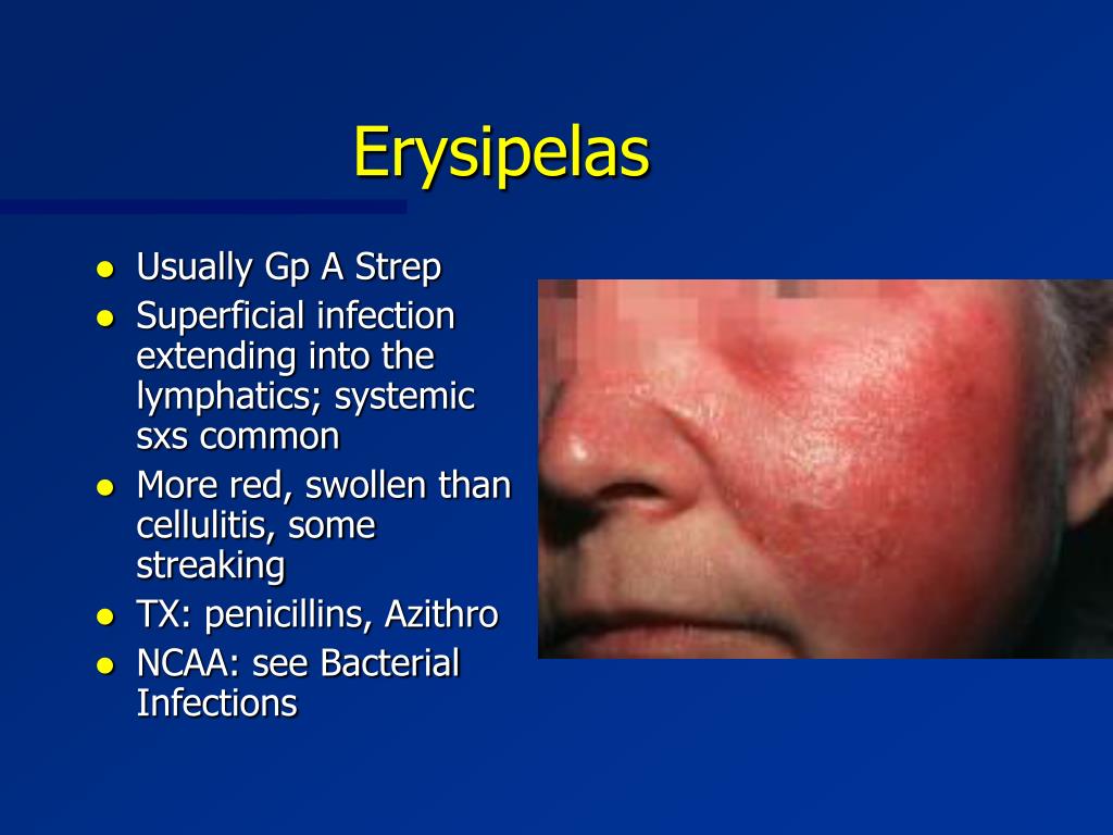 Cellulitis warm or cold compress gamerfiln
