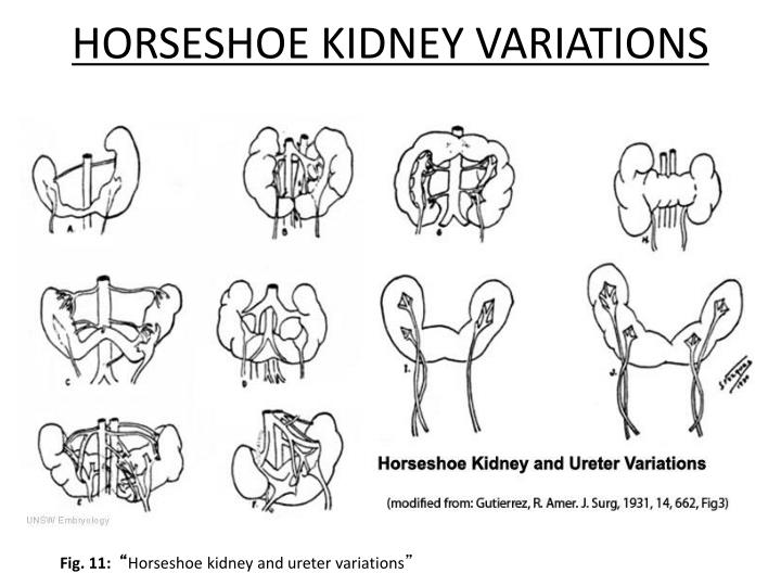 Horseshoe Kidney Features At Linda Redmon Blog Horseshoe Kidney Features At Linda Redmon Blog