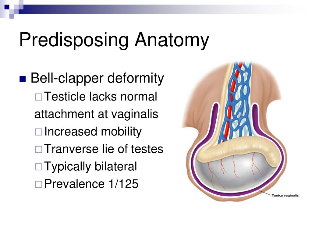 Bell-clapper deformity * Testicle lacks normal attachment at vaginalis * In...