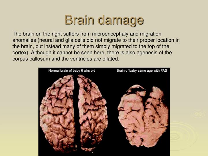 PPT Fetal Alcohol Syndrome Manish Saran MD Department of Psychiatry PowerPoint Presentation