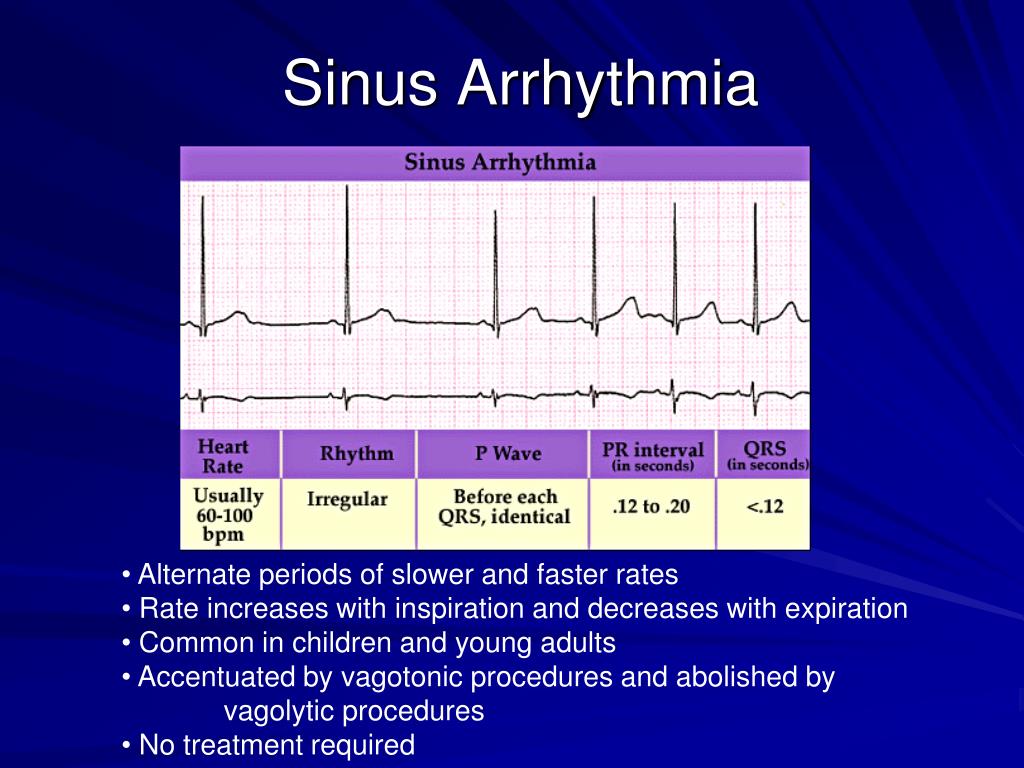 arrhythmia causes arrhythmia causes