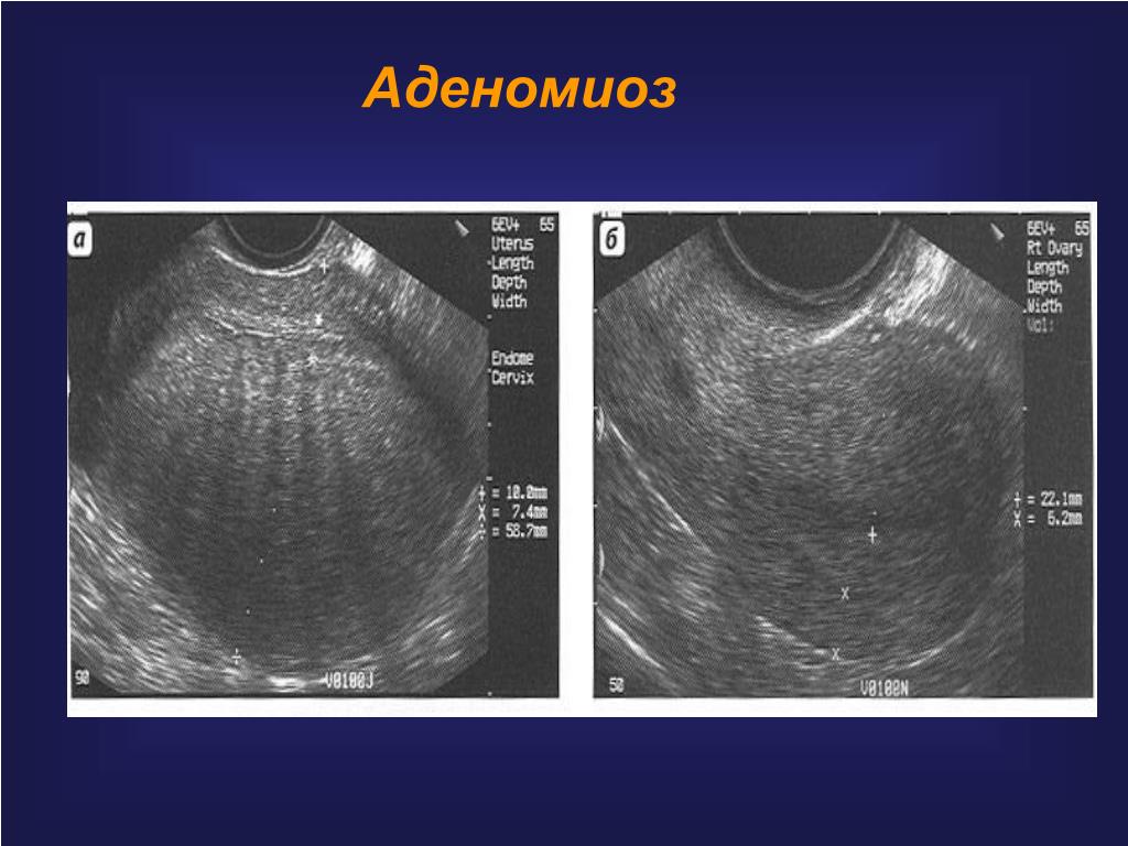 Узи признаки эндометриоза матки. Узловая форма аденомиоза матки на УЗИ. Диффузный эндометриоз матки УЗИ. УЗИ картина аденомиоз матки.