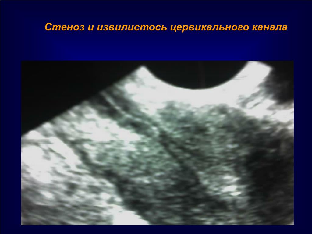 Хронический эндоцервицит что это. Синехии в полости матки на УЗИ. Полип цервикального канала на УЗИ. Хронический эндоцервицит по УЗИ. Стеноз цервикального канала.