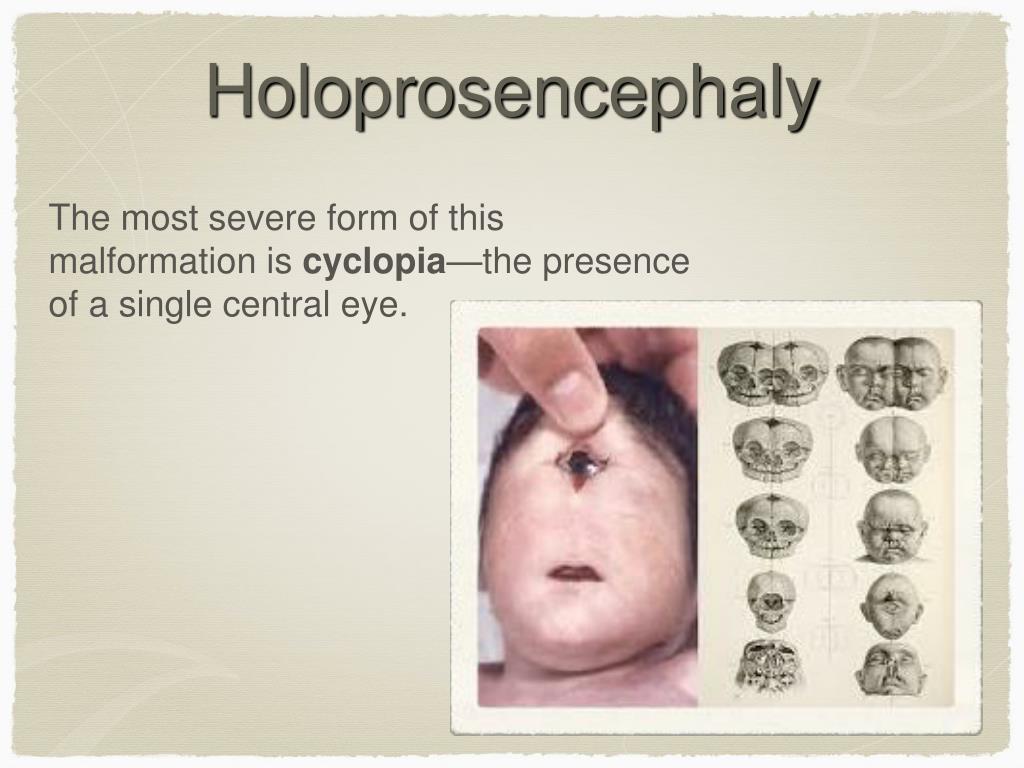 PPT Developmental Genetics And Birth Defects PowerPoint Presentation 
