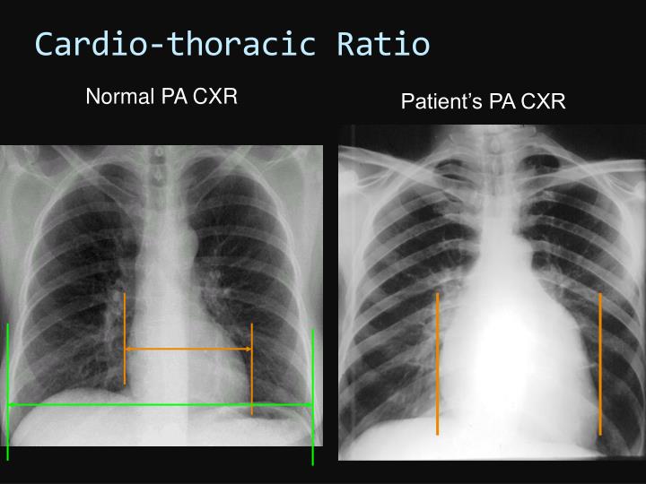 PPT - Chest PA Chest Lat PowerPoint Presentation - ID:3410830