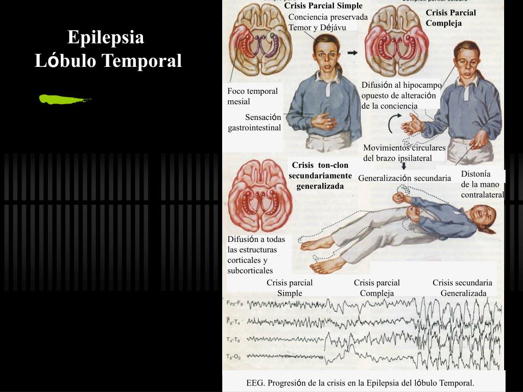 Cetosis para epilepsia