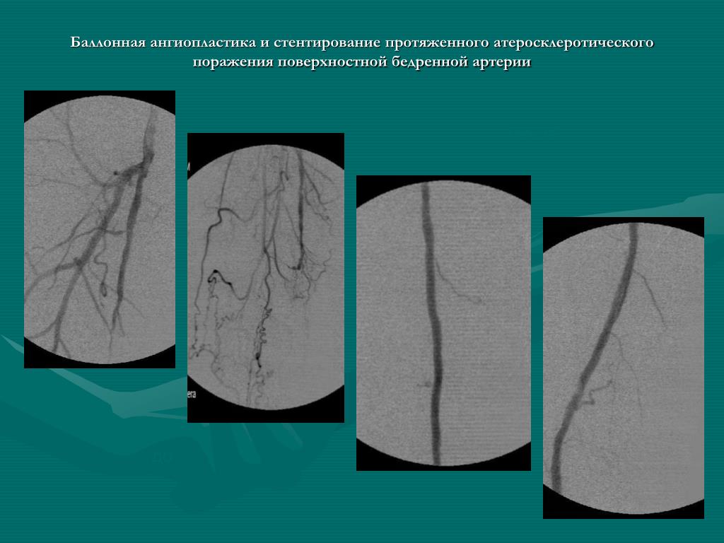 Баллонная ангиопластика артерий. Баллонная ангиопластика и стентирование. ТРАНСЛЮМИНАЛЬНАЯ баллонная ангиопластика и стентирование. Баллонная ангиопластика сосудов нижних конечностей. Баллонная ангиопластика бедренной артерии.