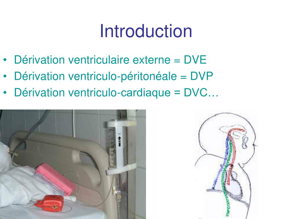 ppt-fi-vre-chez-un-patient-porteur-d-un-drain-ventriculaire