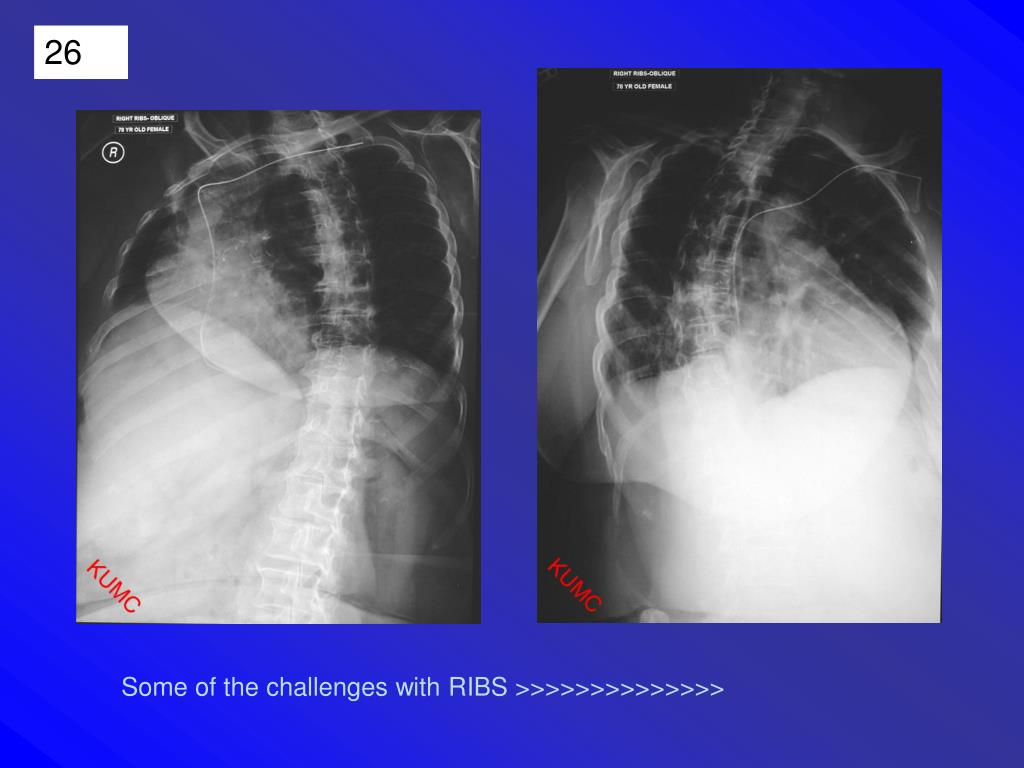 PPT - PA -anterior side BEST SEEN AP -posterior side BEST SEEN ...