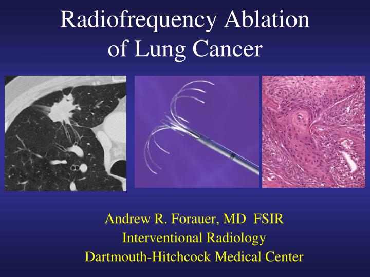 PPT Radiofrequency Ablation of Lung Cancer PowerPoint