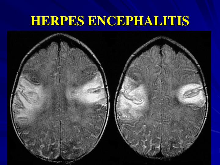 PPT Neonatal Herpes Simplex Infection PowerPoint Presentation ID PPT Neonatal Herpes Simplex Infection PowerPoint Presentation ID