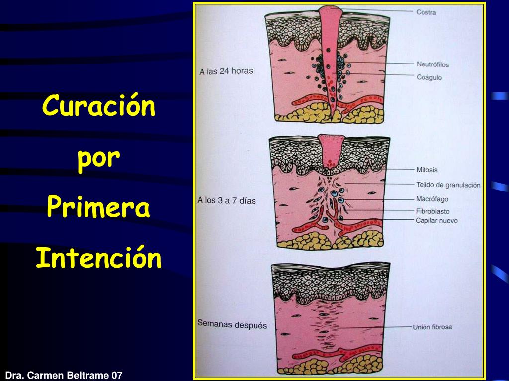 PPT - INFLAMACIÓN CRÓNICA REPARACIÓN PowerPoint Presentation, free
