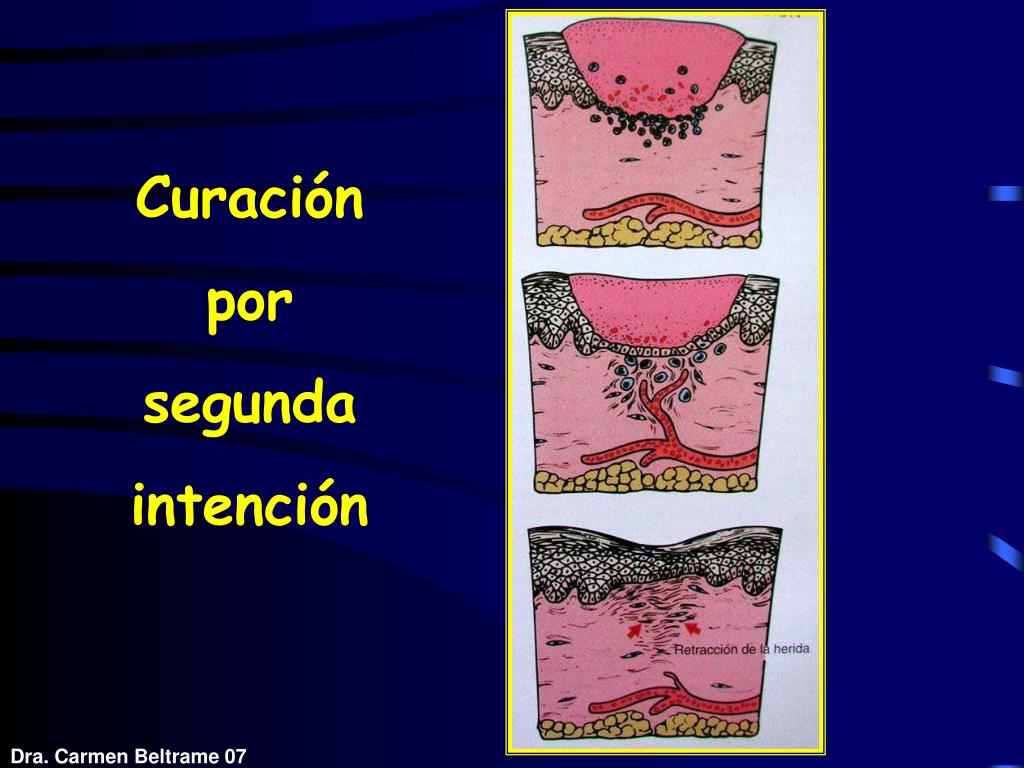 PPT - INFLAMACIÓN CRÓNICA REPARACIÓN PowerPoint Presentation, free