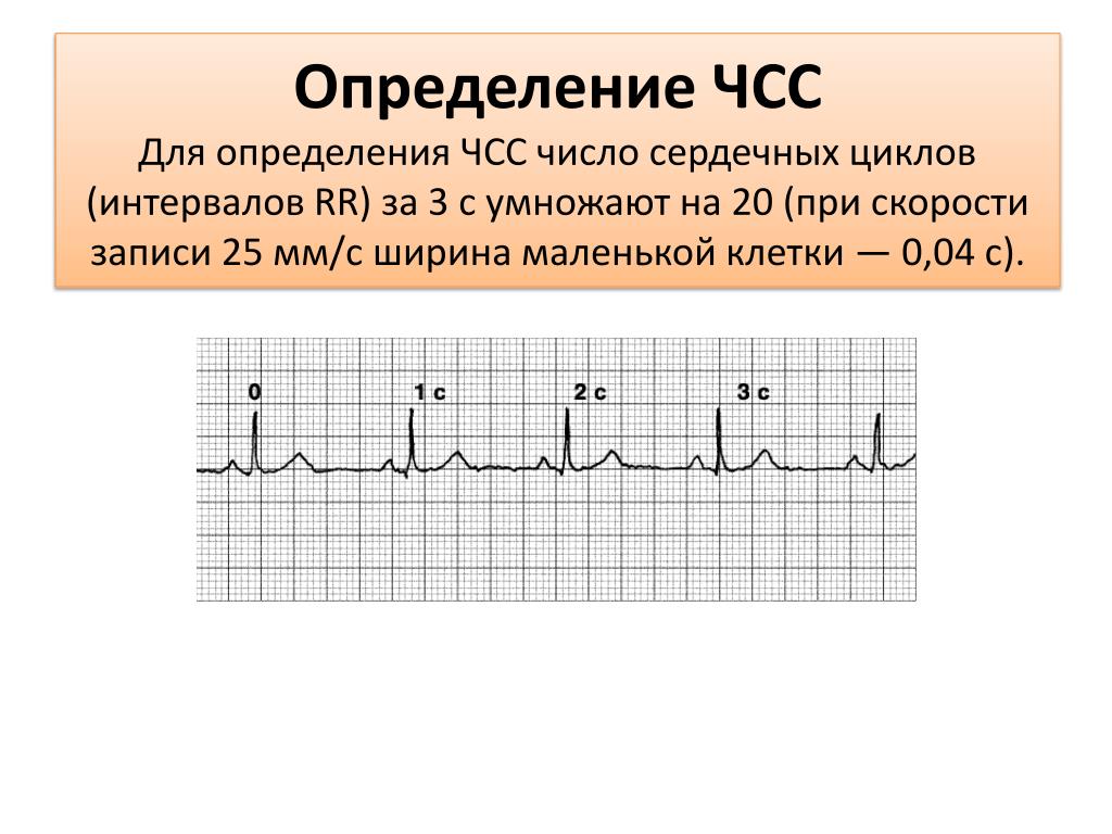 Экг со скольки. Формула ЧСС по ЭКГ 25 мм. ЧСС по ЭКГ 50 мм/с. Подсчет ЧСС на ЭКГ 50 мм/с. Частота сердечных сокращений по ЭКГ формула.
