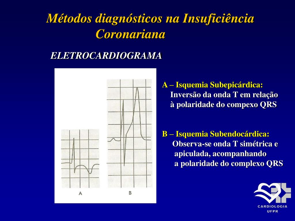 PPT - MÉTODOS DIAGNÓSTICOS NA INSUFICIÊNCIA CORONARIANA PowerPoint  Presentation - ID:3458935, image size:1024x768