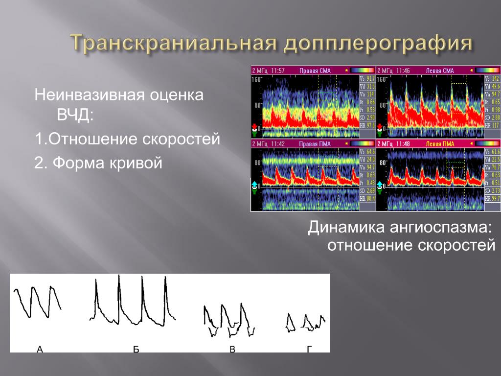 Допплерография. Транскраниальная допплерография. Транскраниальная допплерография ТКДГ. Тканевая допплерография. УЗДГ ТКДГ.