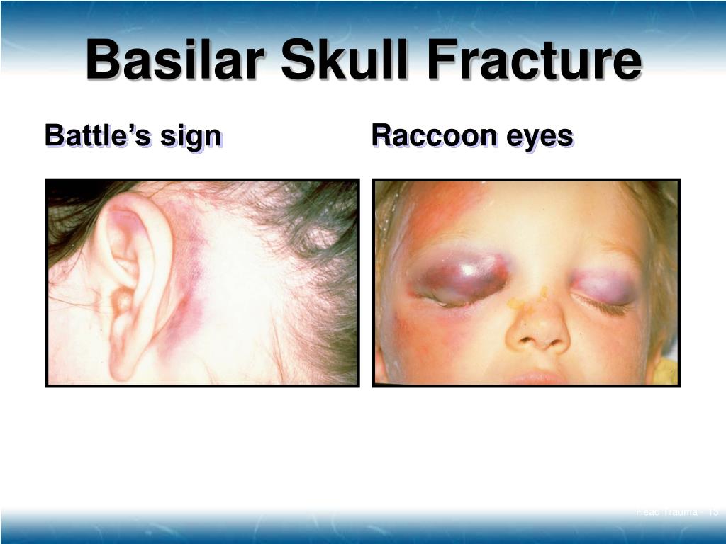 Ppt Head Trauma Powerpoint Presentation Free Download Id3466923