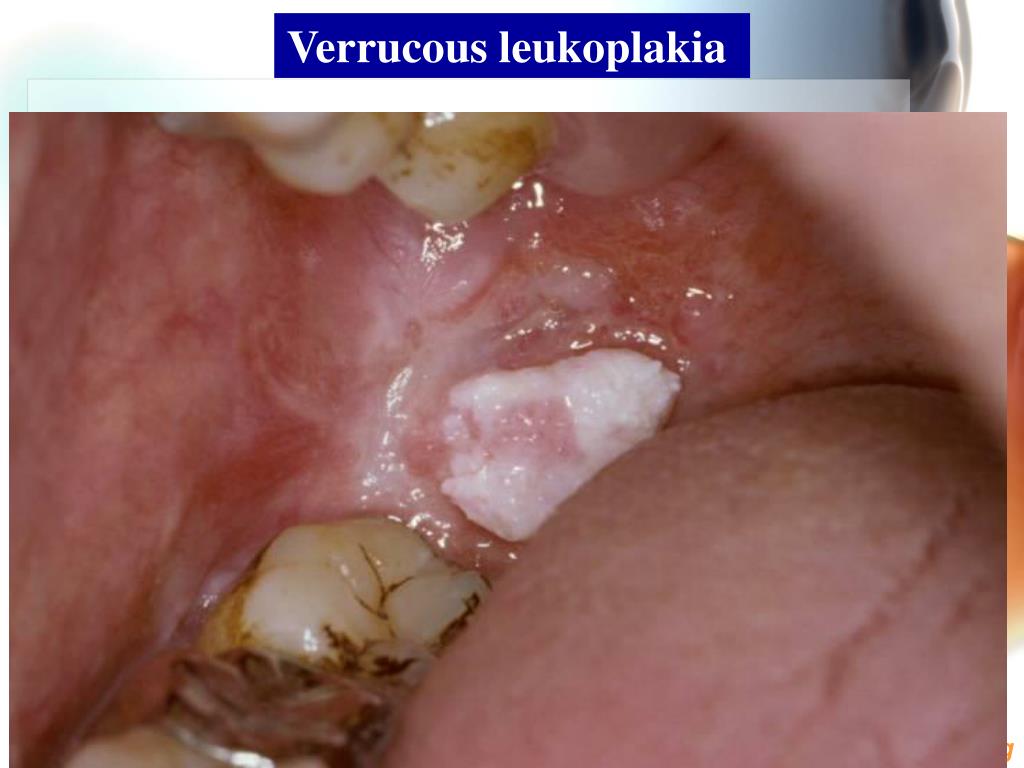 Ppt 1 White Lesions Of The Oral Mucosa 2 Solitary Oral Ulcer And