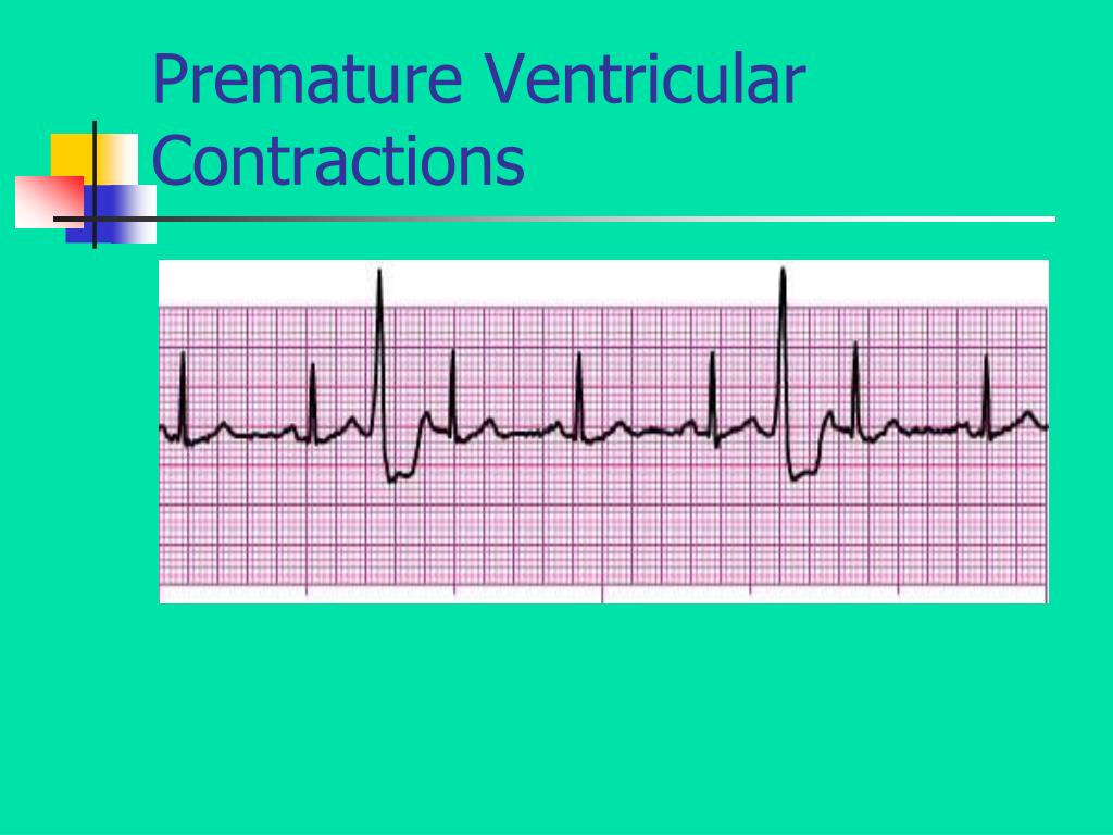 Trigeminal Premature Ventricular Contractions