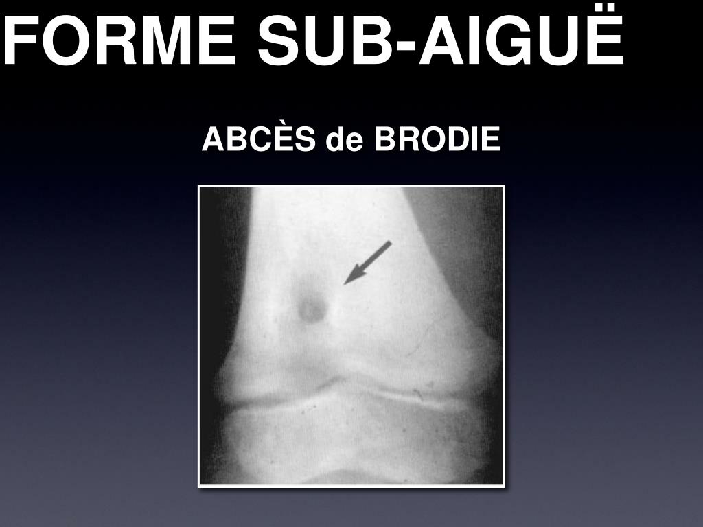 Forme Sub Automorphe PPT - INFECTIONS OSTÉO-ARTICULAIRES DE L’ENFANT PowerPoint Presentation ...